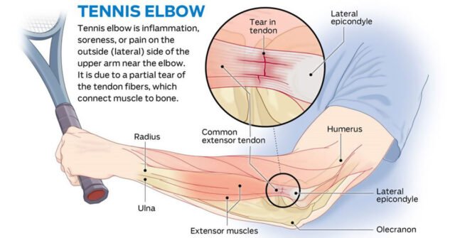 How To Get Rid Of Tennis Elbow F