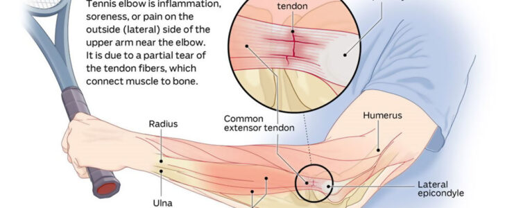 How To Get Rid Of Tennis Elbow F