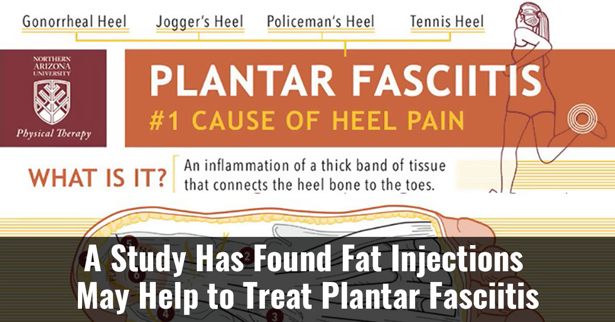 A Study Has Found Fat Injections May Help To Treat Plantar Fasciitis