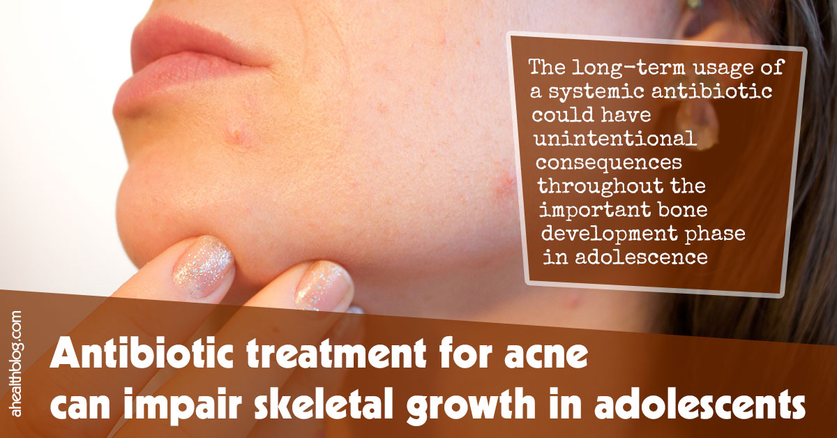 Antibiotic Treatment For Acne Can Impair Skeletal Growth In Adolescents F