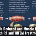 Belly Fat Is Reduced And Muscle Increased With Rf And Hifem Treatment