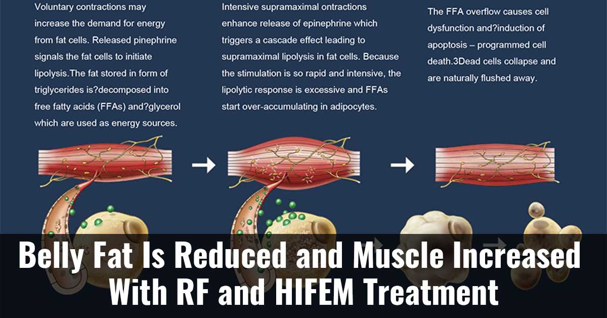 Belly Fat Is Reduced And Muscle Increased With Rf And Hifem Treatment