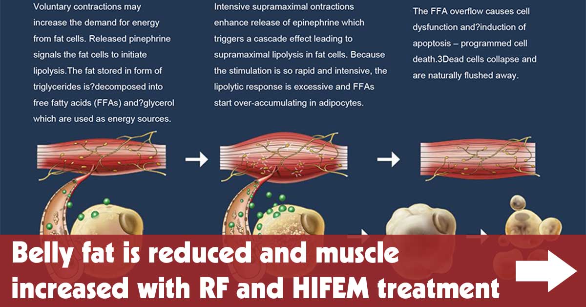 Belly Fat Is Reduced and Muscle Increased With RF and HIFEM Treatment