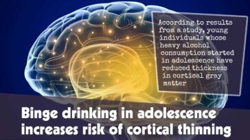 Binge Drinking In Adolescence Increases Risk Of Cortical Thinning F