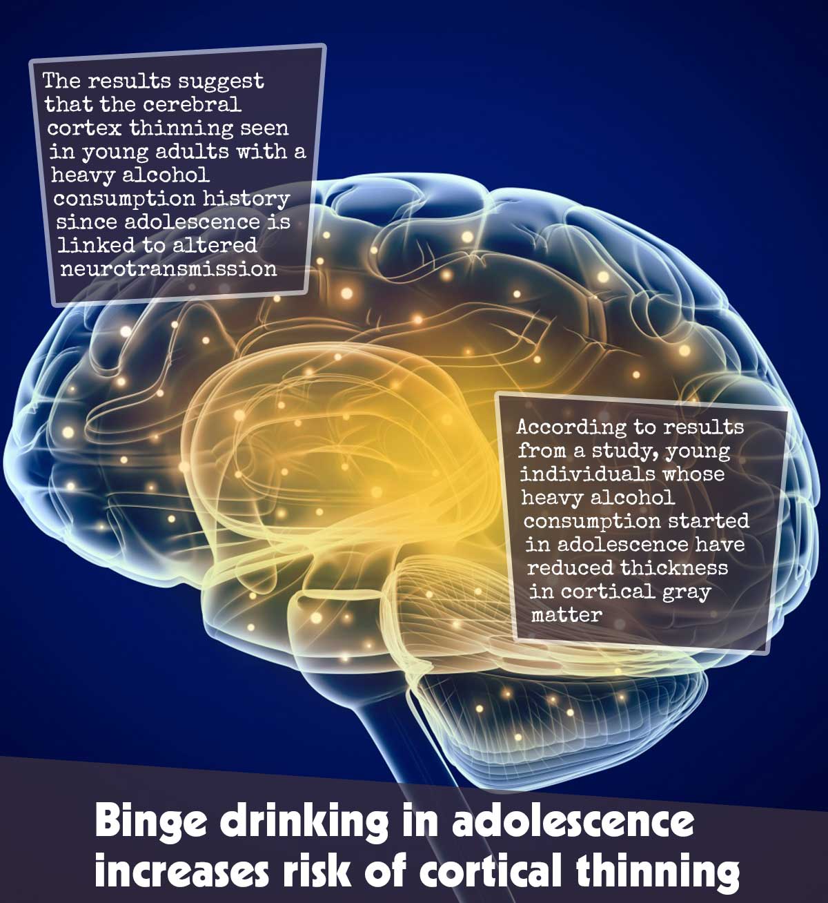 Binge drinking in adolescence increases the risk of cortical thinning