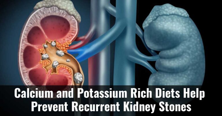 Calcium And Potassium Rich Diets Help Prevent Recurrent Kidney Stones