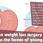 Common Weight Loss Surgery Weakens The Bones Of Young People F