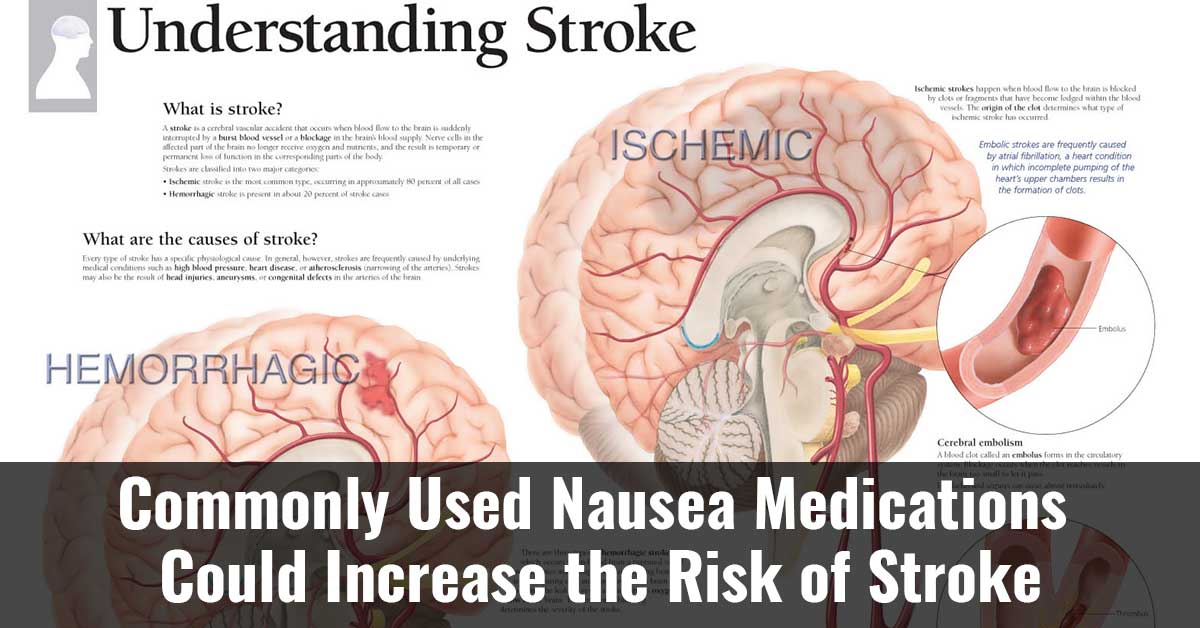 Commonly Used Nausea Medications Could Increase The Risk Of Stroke