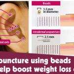 Ear Acupuncture Using Beads Could Help Boost Weight Loss Efforts F