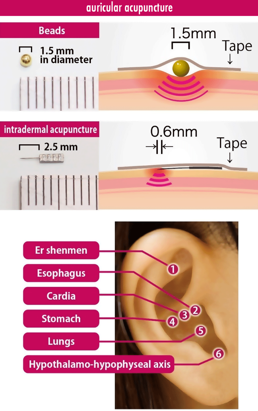 Ear Acupuncture Using Beads Could Help Boost Weight Loss Efforts