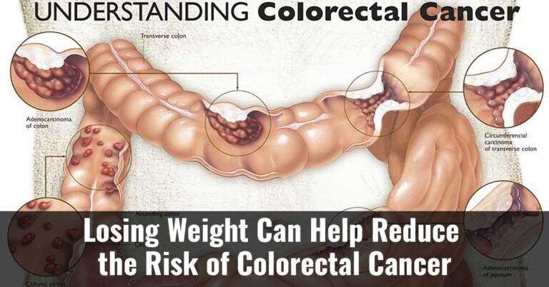 Losing Weight Can Help Reduce The Risk Of Colorectal Cancer