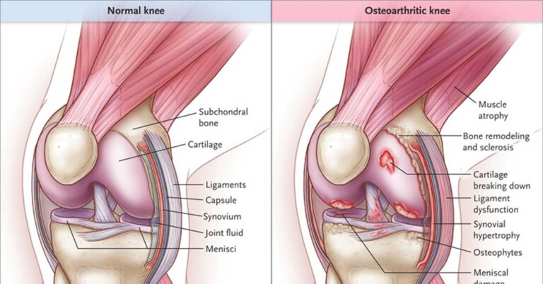 Osteoarthritis Of The Knee Anatomy F