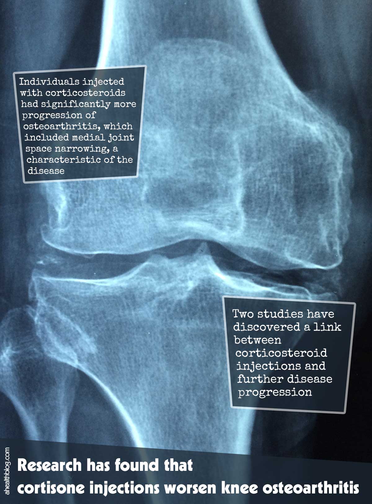 Research Has Found That Cortisone Injections Worsen Knee Osteoarthritis