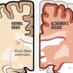 The Liver May Play An Important Part In Alzheimers Disease F