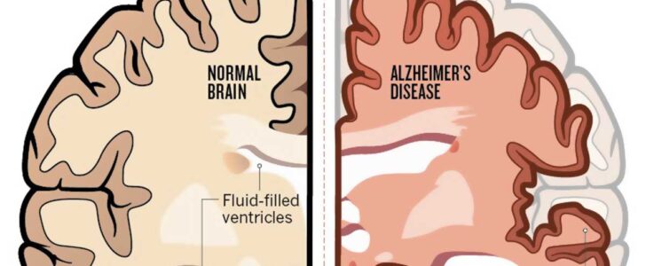 The Liver May Play An Important Part In Alzheimers Disease F