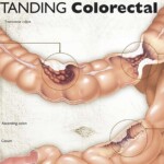 Understanding Colorectal Cancer Anatomical Chart F