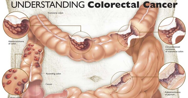Understanding Colorectal Cancer Anatomical Chart F