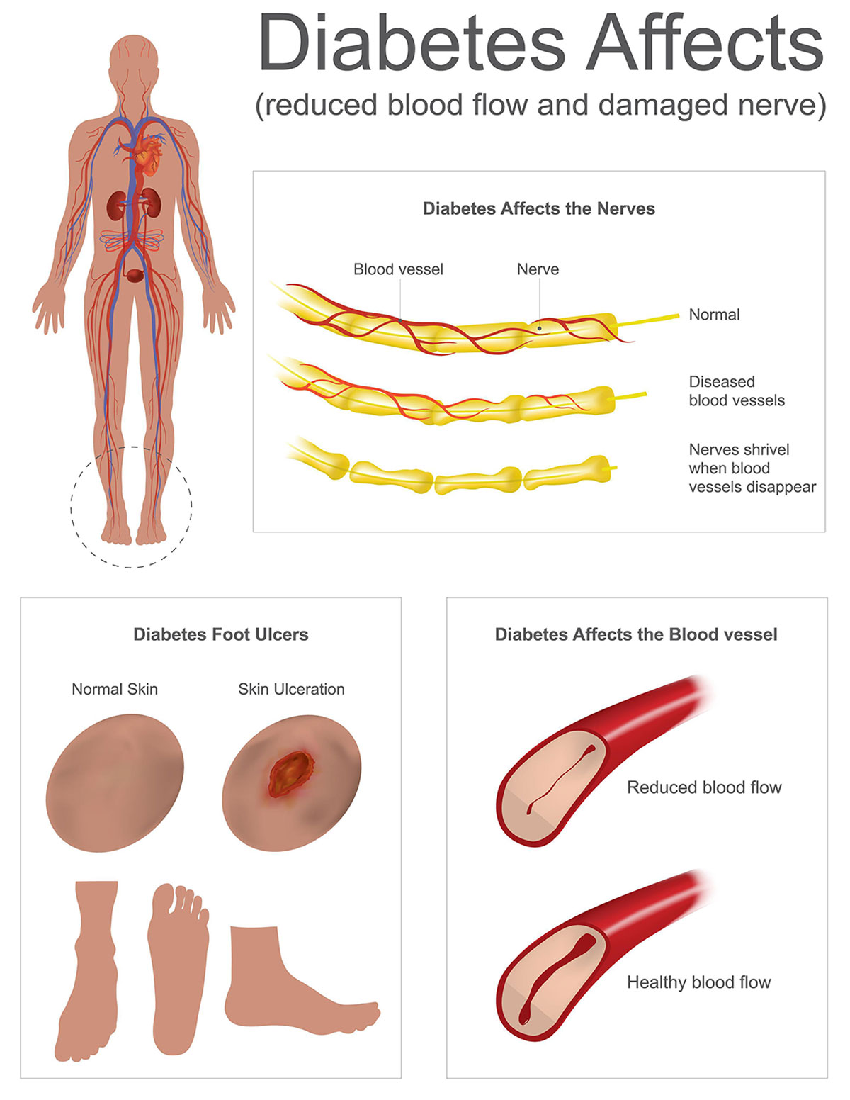 Diabetic Vascular Disease Infographic