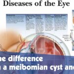 Diseases Of The Eye Chart F